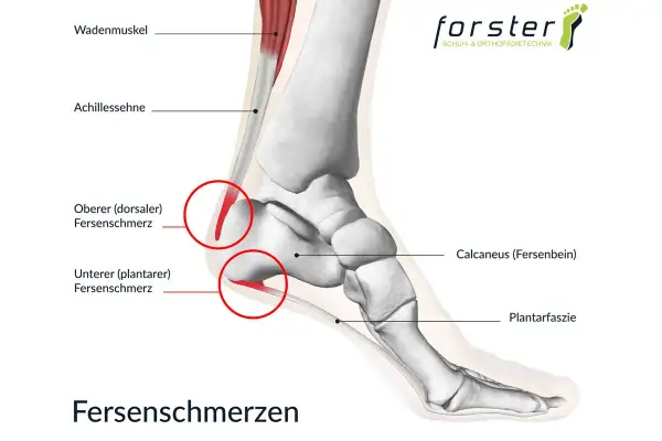Anatomische Darstellung des Fußes mit Fokus auf Fersenschmerzen. Die Achillessehne und der Wadenmuskel sind sichtbar. Rote Kreise markieren Schmerzbereiche an der Achillessehne und der Plantarfaszie.