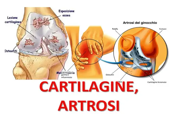 Illustrazione anatomica del ginocchio con artrosi, che mostra lesioni cartilaginee, esposizione ossea e osteofiti. Il ginocchio si piega al ginocchio.