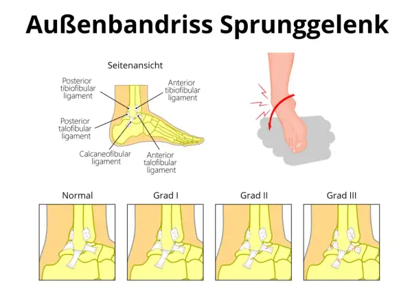 Illustration zeigt einen Bänderriss am Sprunggelenk, mit Fokus auf das ligamentum fibulotalare anterius und verschiedene Schweregrade.