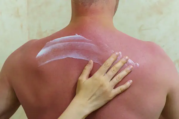 Eine Hand trägt Salbe auf einen stark sonnenverbrannten, roten Rücken auf.
