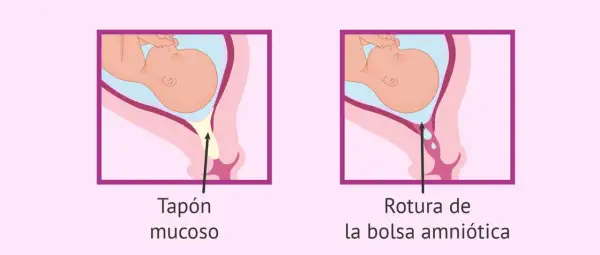 Ilustración comparativa: tapón mucoso y rotura de la bolsa amniótica, señales del parto en la semana 37.