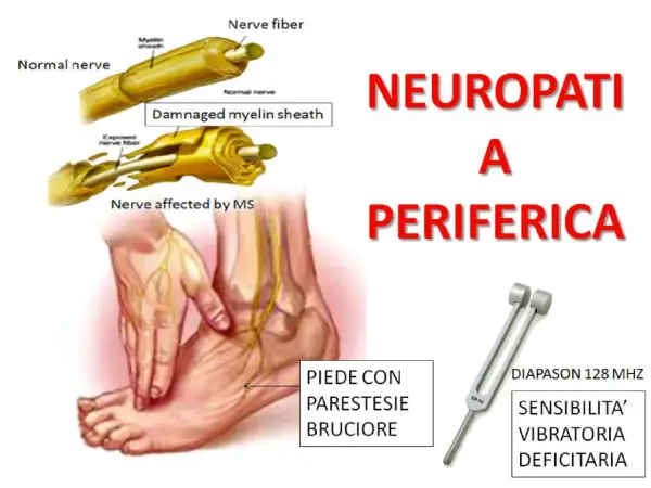 Immagine illustra cosa vuol dire neuropatia periferica: nervi sani e danneggiati, un piede con parestesie e bruciore, e un diapason per testare la sensibilità vibratoria.