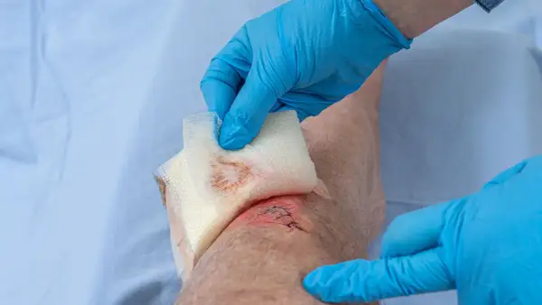 Blaue Handschuhe bedecken eine genähte, offene Wunde am Knie, die mit Gaze abgetupft wird.