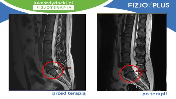 Rezonans magnetyczny kręgosłupa lędźwiowego przed i po terapii. Widoczna dyskopatia L5 S1 objawy, zaznaczone czerwonym okręgiem i strzałką.