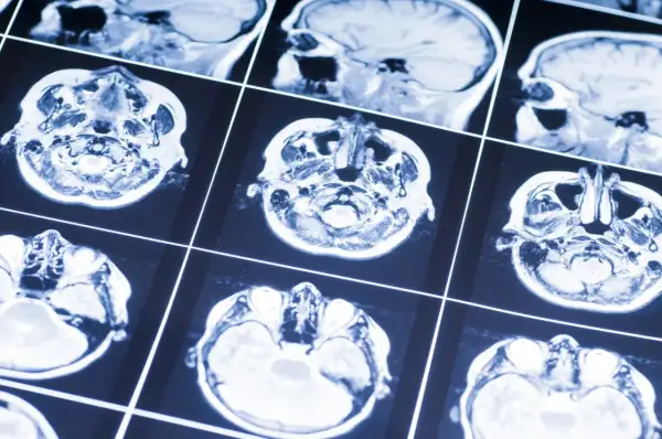 Przekroje mózgu na rezonansie magnetycznym. Obraz może pomóc w diagnostyce oponiak objawy, analizując strukturę tkanki mózgowej.