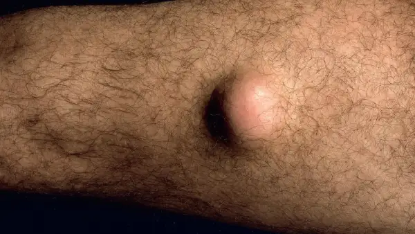 Ein gutartiger Tumor, eine helle, runde Beule, hebt sich auf der behaarten Haut eines Arms ab.