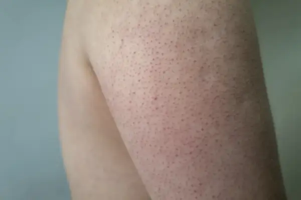 Närbild på arm med keratosis pilaris. Små röda prickar syns över hela huden, vilket kan vara ett tecken på att behandling behövs.
