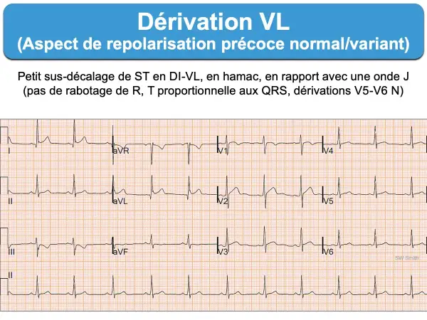 Électrocardiogramme montrant une dérivation VL avec un léger sus-décalage de ST, aspect de repolarisation précoce. L'ECG D2 long révèle une onde J.