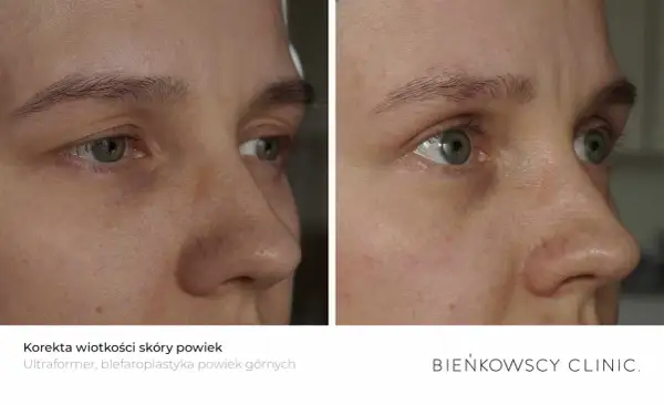Opadająca powieka przed i po zabiegu. Poprawa jędrności skóry wokół oczu, widoczna na zdjęciach porównawczych.