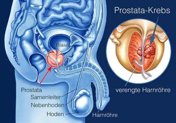 Anatomie der männlichen Beckenorgane mit Fokus auf Prostatakrebs. Ein vergrößerter Ausschnitt zeigt Tumore in der Prostata, die die Harnröhre verengen. Mögliche Prostatakrebs-Metastasen sind angedeutet.