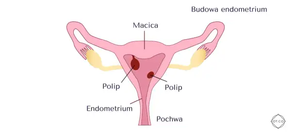 Schemat budowy macicy z widocznymi polipami w obrębie endometrium.