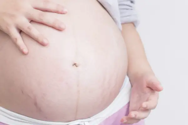 Barriga de embarazada con estrías moradas, un signo de la vida que crece.