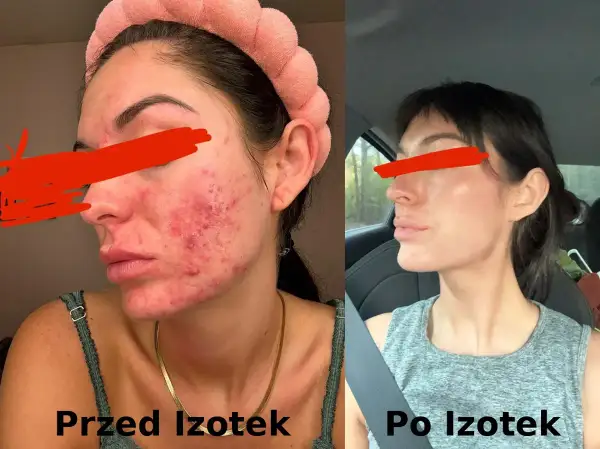 Przed i po leczeniu izotekiem: skóra z trądzikiem i zaczerwienieniem przechodzi transformację w gładką i czystą cerę.