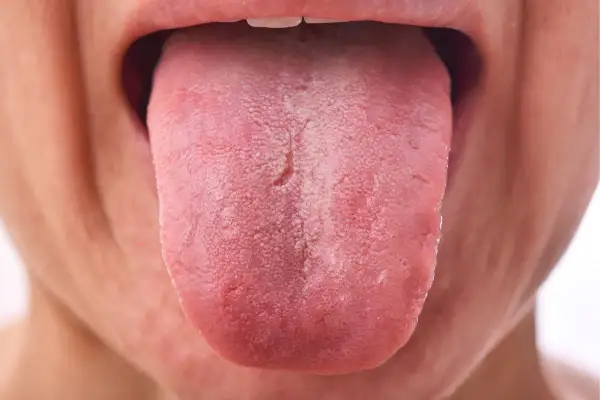 Lengua rosada con una capa blanquecina, posiblemente por uso de clorhexidina.