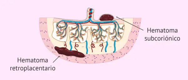 Ilustración de hematoma subcoriónico y retroplacentario, mostrando cómo se expulsa un hematoma en el embarazo.