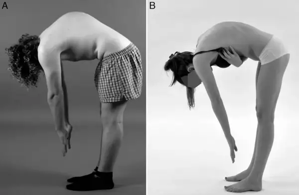 Comparaison avant/après d'une cyphose : un homme et une femme se penchent, montrant la courbure de leur colonne vertébrale.