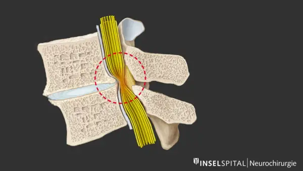 Darstellung einer Spinalkanalstenose, die den Nervenstrang komprimiert. Mögliche Indikation für eine spinalkanalstenose op.