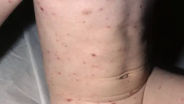 Barnets hud täckt av röda prickar, typiska för vattkoppor.