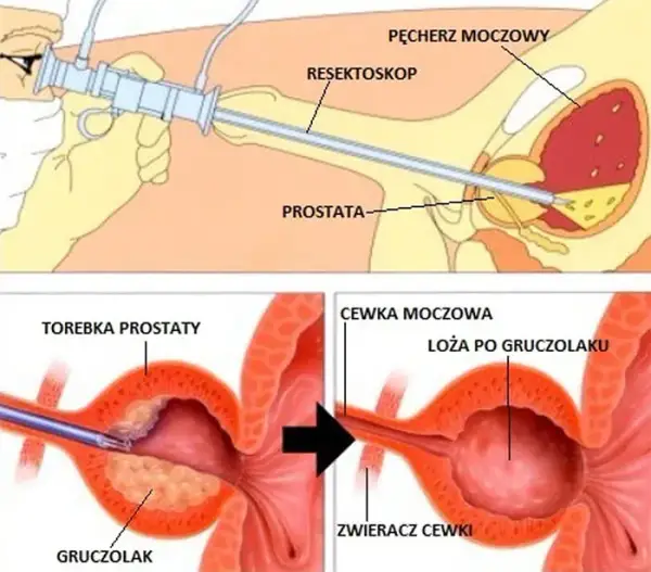 Czy pacjent ma prawo do sanatorium po operacji prostaty? Sprawdź warunki