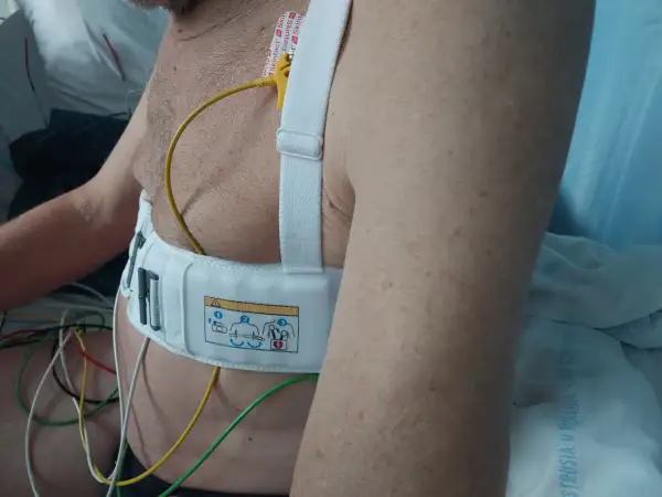 Pacjent z kardiowerterem-defibrylatorem wszczepionym pod skórę, z widocznymi elektrodami i przewodami.