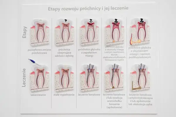 Grafika pokazuje etapy rozwoju próchnicy i jej leczenia, od początkowej zmiany do ropnia zęba, a następnie metody leczenia, w tym leczenie kanałowe.