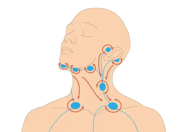 Illustration zeigt Lymphknoten im Halsbereich mit Pfeilen, die den Lymphfluss darstellen. Die Lymphknoten haben eine normale Größe.