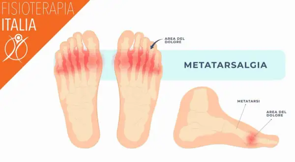 Illustrazione anatomica che mostra la metatarsalgia, un'area di dolore ai metatarsi delle dita dei piedi, evidenziata in rosso.
