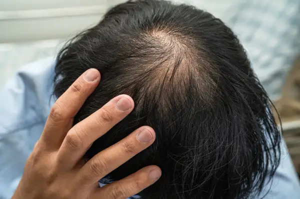 Vue rapprochée du sommet de la tête d'un homme montrant une calvitie naissante. La main d'un homme touche son cuir chevelu, peut-être en réfléchissant à la cause de sa calvitie.