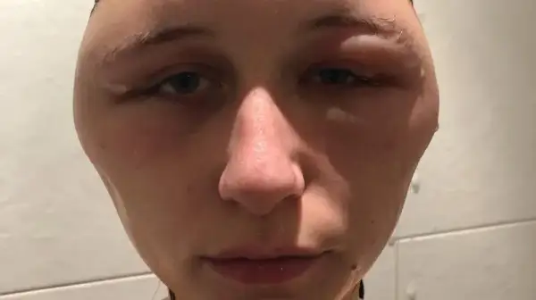Alergia na farby do włosów objawy - jak uniknąć niebezpiecznych reakcji
