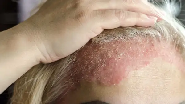 Dłoń dotyka czoła z widocznym zaczerwienieniem i łuszczącą się skórą głowy, co może wskazywać na problem dermatologiczny.