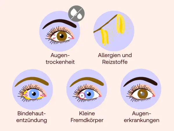 Illustrationen zeigen Ursachen für brennende Augen: Trockenheit, Allergene, Bindehautentzündung, Fremdkörper und allgemeine Augenerkrankungen.