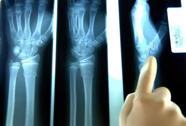Radiografie del polso mostrano una mano con possibile distorsione al polso. Un dito indica un'area di interesse.