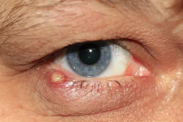 Ein entzündeter Gerstenkorn am Augenlid, der Juckreiz verursacht. Das Auge ist rot und geschwollen.