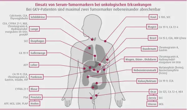 Schema zeigt Tumormarker wie CEA für verschiedene Organe, z.B. Lunge, Pankreas, Kolon/Rektum, zur Diagnose onkologischer Erkrankungen.