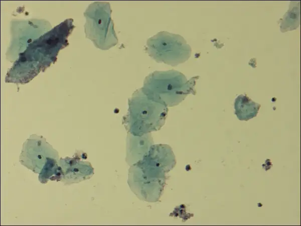 Cellules épithéliales et quelques bactéries, possiblement liées à la gardnerella transmission par l'homme.
