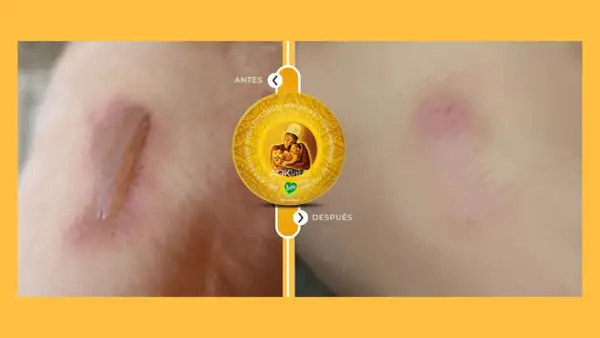 Antes y después de usar la grasa de shea: una cicatriz mejora visiblemente.