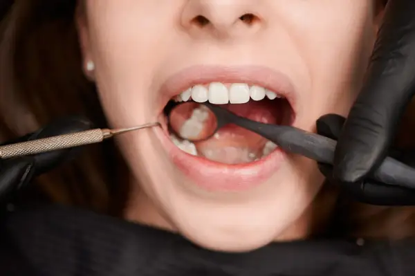 Usta kobiety otwarte, dentysta w czarnej rękawiczce bada ząb mądrości lusterkiem i narzędziem.