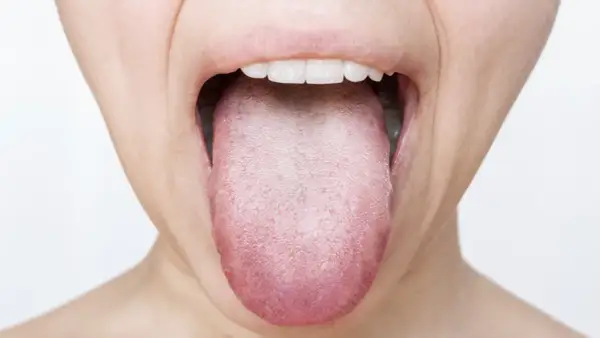 Lingua arrossata e con papille evidenti, possibile segno di candidosi orale.