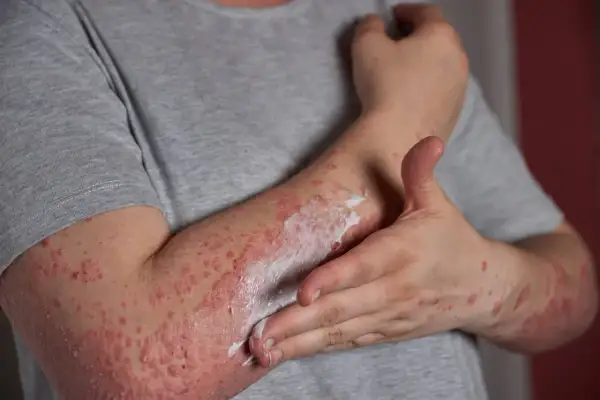Person cremt Arm mit Neurodermitis ein. Die Haut ist gerötet und schuppig. Die richtige Kleidung bei Neurodermitis ist wichtig.
