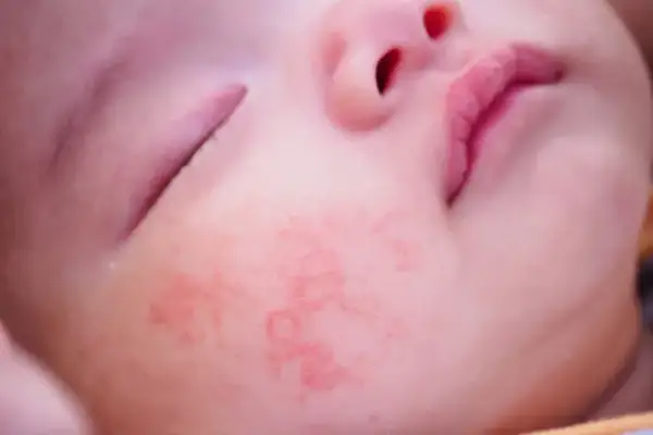 Alergia na białko mleka krowiego objawy – jak je rozpoznać i unikać?