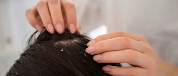 Dłonie rozgarniają ciemne włosy, ukazując łuszcząca się skórę głowy z widocznym łupieżem.