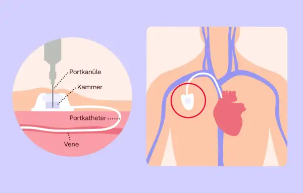 Schema zeigt ein medizinisches Portsystem: eine Nadel (Portkanüle) in der Kammer, verbunden mit einem Katheter in einer Vene. Das Port-System liegt nahe dem Herzen.