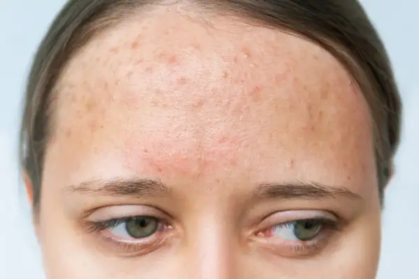 Alergia na mleko u dorosłych: objawy skórne, diagnoza i leczenie