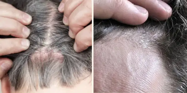 Primer plano de un cuero cabelludo con descamación, mostrando piel irritada y escamas blancas entre el cabello.