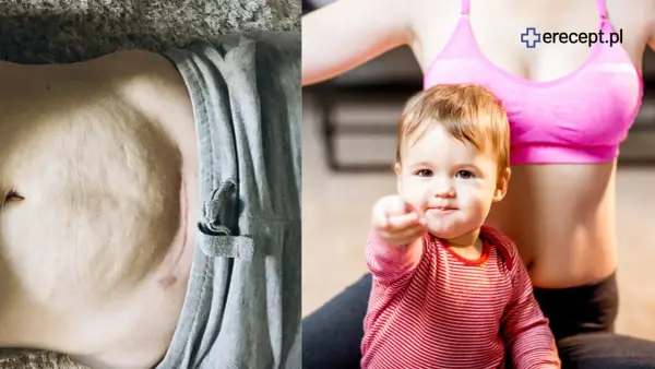Brzuch po ciąży i dziecko. Jak schudnąć po ciąży? Ćwiczenia i dieta to klucz do sukcesu.