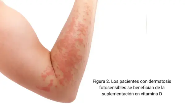 Brazo con erupción cutánea roja y elevada. La vitamina D es clave para la salud de la piel, especialmente para quienes sufren de dermatosis fotosensibles.