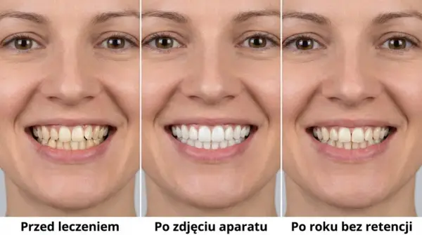 Aparat retencyjny - Jak utrzymać idealny uśmiech po leczeniu?
