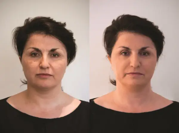Porównanie twarzy kobiety przed i po zabiegu, ukazujące zmiany w wyglądzie.