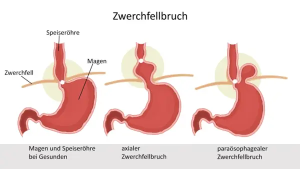 Illustrationen zeigen Zwerchfellbruch-Arten. Symptome bei Frauen können vielfältig sein, hier axialer und paraösophagealer Bruch.
