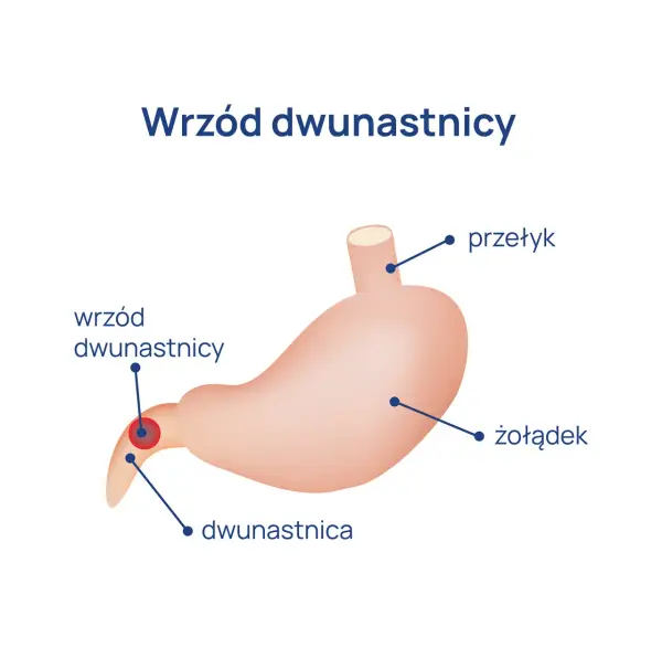 Ból dwunastnica objawy – poznaj sygnały, które mogą niepokoić